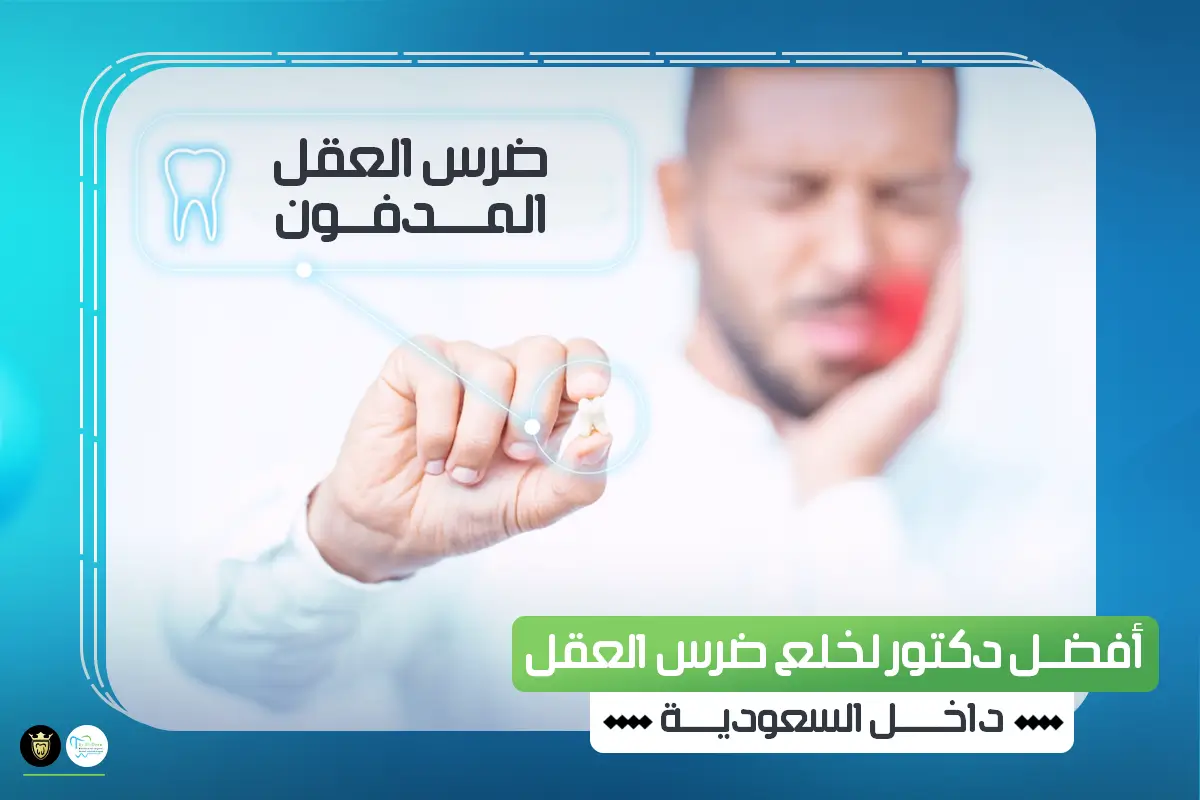 افضل دكتور لخلع ضرس العقل