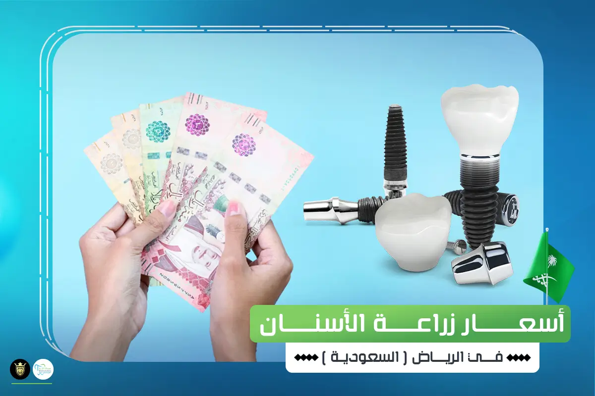 اسعار زراعة الاسنان في الرياض